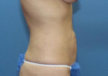 Tummy Tuck Patient Photo - Case 100 - before view-1