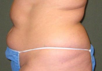 Tummy Tuck Patient Photo - Case 96 - before view-1