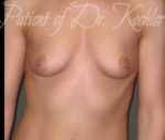 Breast Augmentation - Case 20 - Before