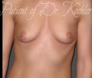 Breast Augmentation Patient Photo - Case 20 - before view-0