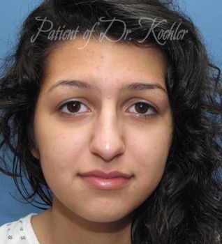Rhinoplasty Patient Photo - Case 89 - before view-