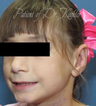 Ear Surgery Patient Photo - Case 75 - after view-2