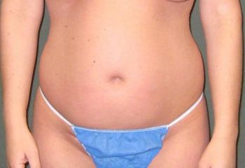 Tummy Tuck Patient Photo - Case 101 - before view-
