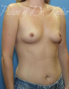 Breast Augmentation Patient Photo - Case 44 - before view-2