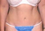 Tummy Tuck - Case 96 - After
