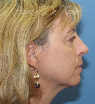 Cheek Implant Patient Photo - Case 73 - before view-1