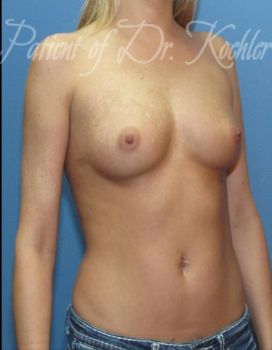 Breast Augmentation Patient Photo - Case 37 - before view-2