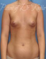 Breast Augmentation - Case 16 - Before