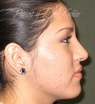 Rhinoplasty Patient Photo - Case 90 - after view-1