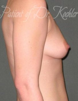 Breast Augmentation Patient Photo - Case 18 - before view-1