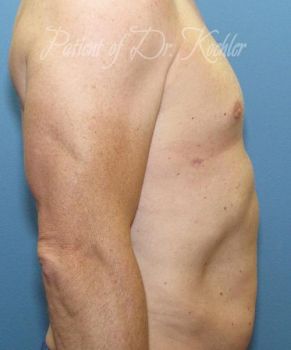 Gynecomastia Patient Photo - Case 84 - after view-1
