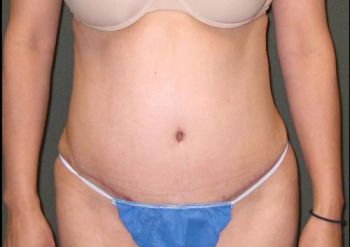 Tummy Tuck Patient Photo - Case 99 - after view-0