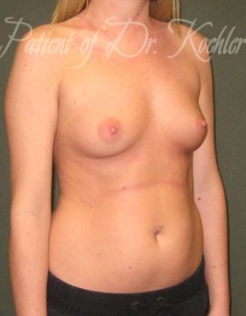 Breast Augmentation Patient Photo - Case 22 - before view-2