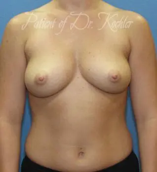 Breast Augmentation Patient Photo - Case 55 - before view-
