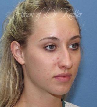 Rhinoplasty Patient Photo - Case 88 - before view-2