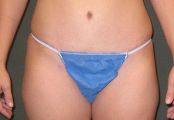 Tummy Tuck Patient Photo - Case 94 - after view