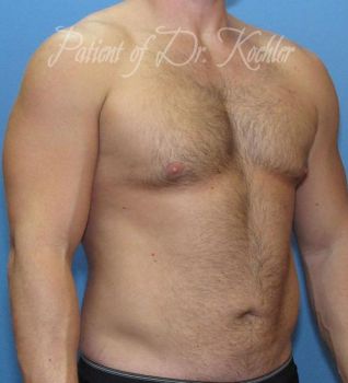 Liposuction Patient Photo - Case 83 - after view-1
