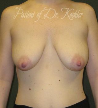 Breast Augmentation/Lift Patient Photo - Case 62 - before view-0
