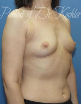 Breast Augmentation Patient Photo - Case 41 - before view-2
