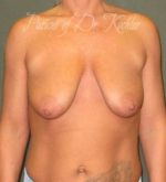 Breast Augmentation/Lift - Case 64 - Before