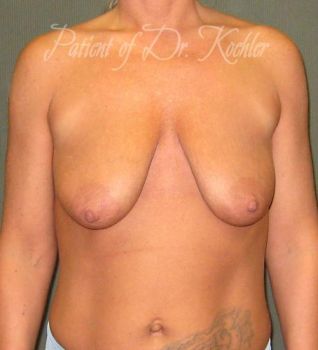 Breast Augmentation/Lift Patient Photo - Case 64 - before view-0