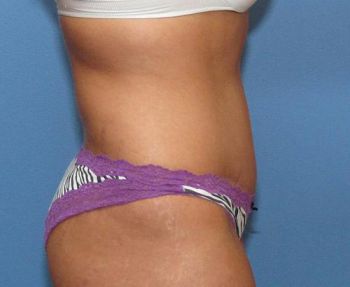 Tummy Tuck Patient Photo - Case 98 - after view-1