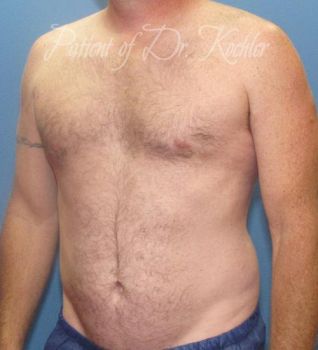 Liposuction Patient Photo - Case 80 - before view-1