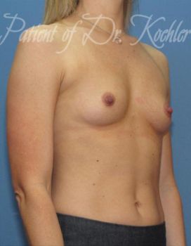 Breast Augmentation Patient Photo - Case 35 - before view-2