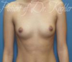 Breast Augmentation - Case 30 - Before