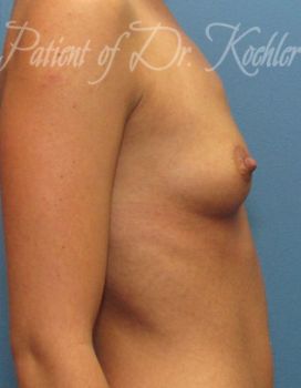 Breast Augmentation Patient Photo - Case 32 - before view-1