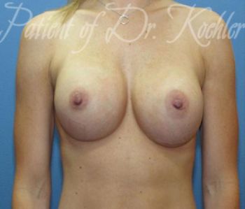 Breast Augmentation Patient Photo - Case 35 - after view
