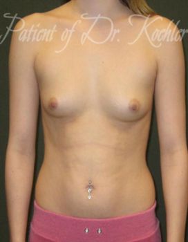 Breast Augmentation Patient Photo - Case 23 - before view-0
