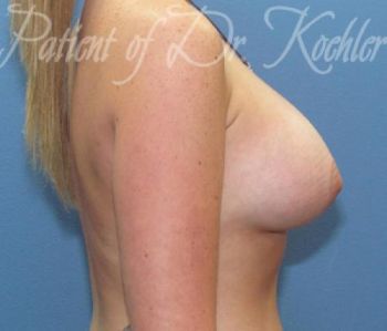 Breast Augmentation Patient Photo - Case 39 - after view-1