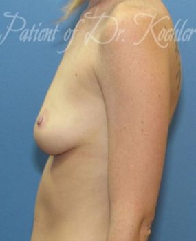 Breast Augmentation Patient Photo - Case 40 - before view-1