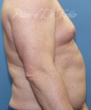 Gynecomastia Patient Photo - Case 84 - before view-1