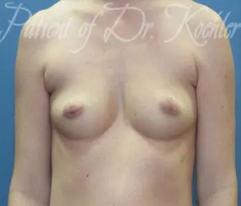 Breast Augmentation Patient Photo - Case 36 - before view-0