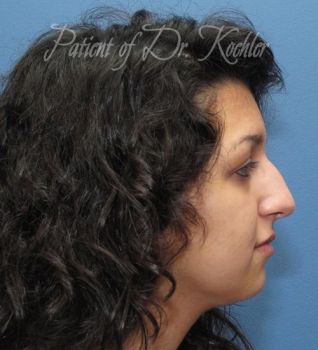 Rhinoplasty Patient Photo - Case 89 - before view-1