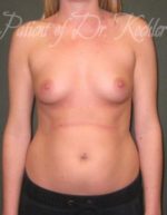 Breast Augmentation - Case 22 - Before