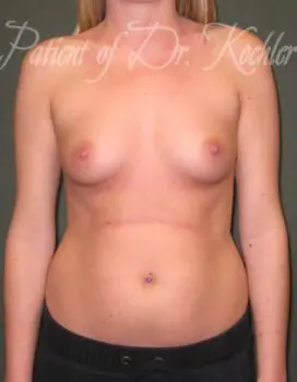 Breast Augmentation Patient Photo - Case 22 - before view-0