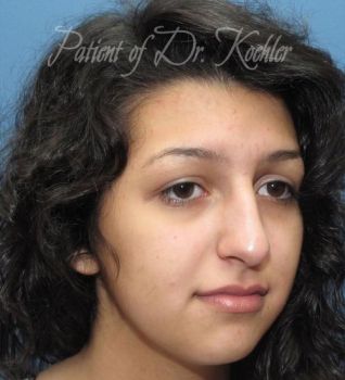 Rhinoplasty Patient Photo - Case 89 - before view-2