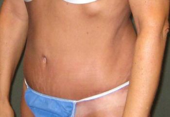 Tummy Tuck Patient Photo - Case 93 - after view-2