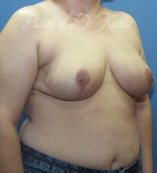 Breast Reduction Patient Photo - Case 66 - after view-2