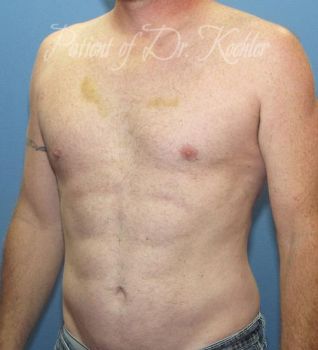 Liposuction Patient Photo - Case 80 - after view-1