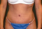 Tummy Tuck - Case 93 - After