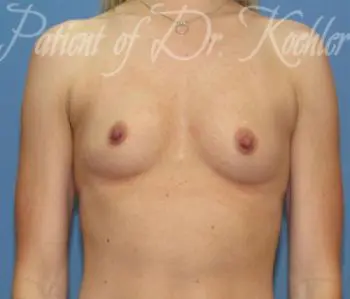 Breast Augmentation Patient Photo - Case 35 - before view-