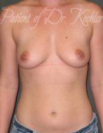 Breast Augmentation - Case 18 - Before