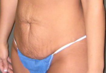 Tummy Tuck Patient Photo - Case 94 - before view-1
