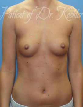 Breast Augmentation Patient Photo - Case 42 - before view-0