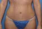 Tummy Tuck - Case 97 - After