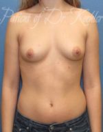 Breast Augmentation - Case 25 - Before